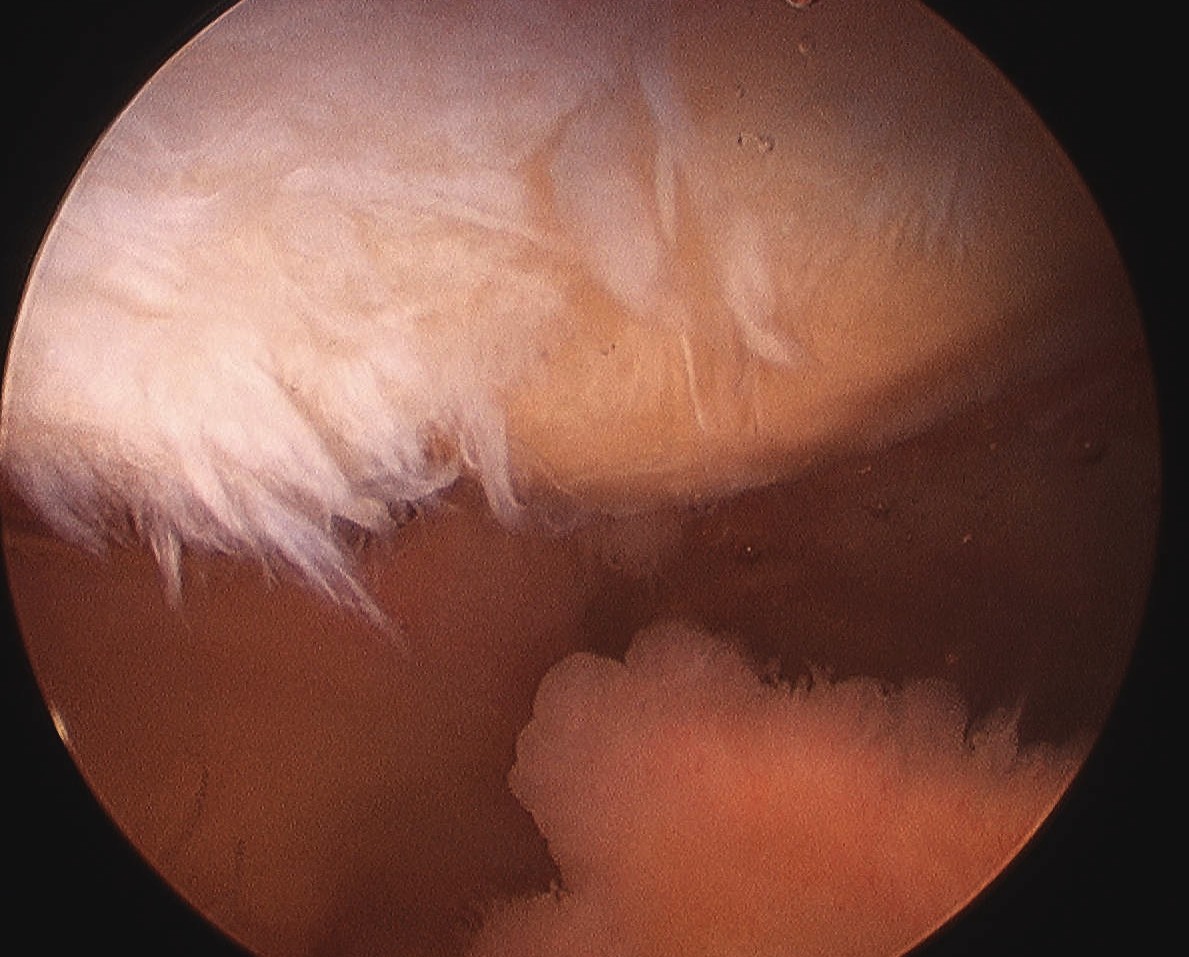 Patella Grade 4 Arthroscopy